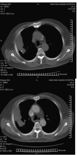 肺炎型肺癌:三大影像学重点帮你防误诊
