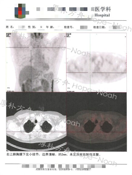 日本治疗甲状腺结节