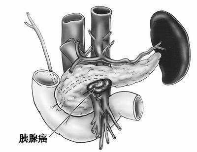 胰腺癌晚期能活多久