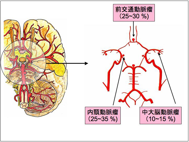 基底动脉巨大脑动脉瘤一例