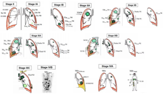 出国看病:肺癌的症状及诊断方法