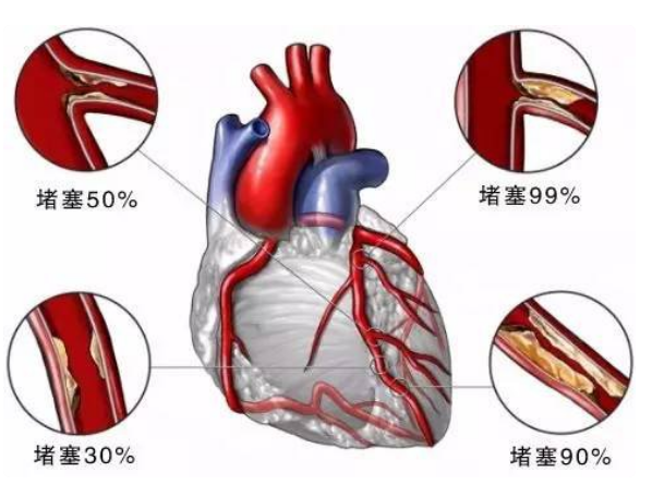 日本预防心脏病
