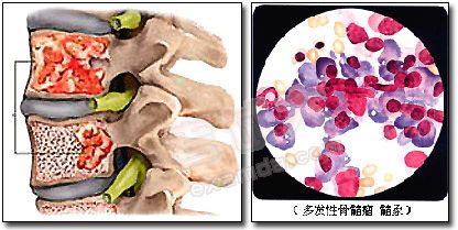 日本骨髓瘤治疗方法
