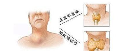 甲状腺结节