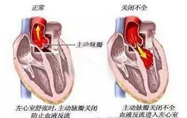 日本心脏瓣膜手术