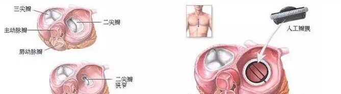 日本心脏瓣膜手术