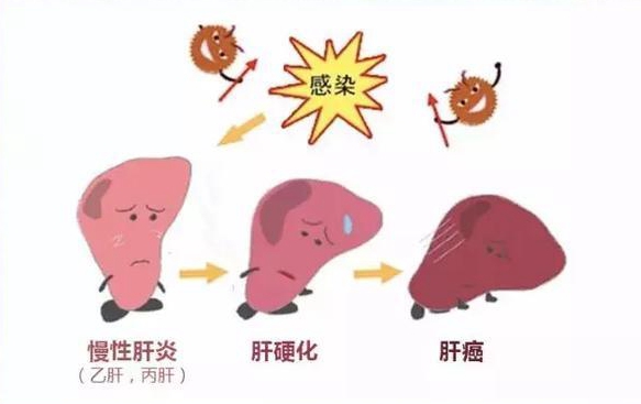 怎样预防肝癌 预防肝癌的措施有哪些