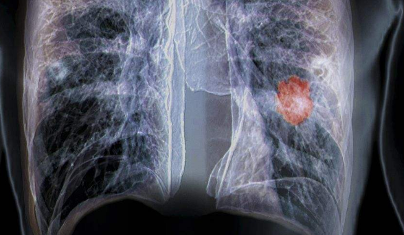 日本看病肺癌