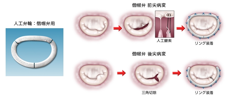 心脏瓣膜病