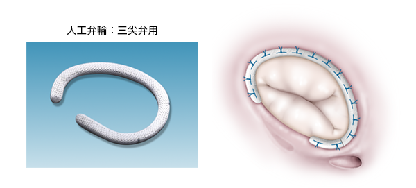 心脏瓣膜病