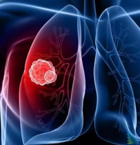美国治疗肺癌