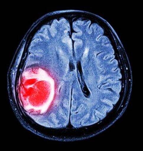 美国脑瘤治疗