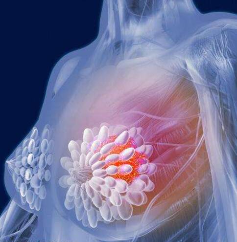 乳腺纤维瘤主要治疗方法有哪些