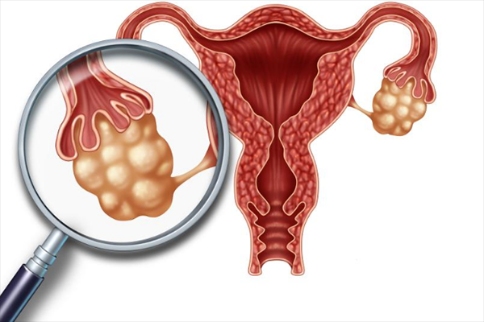 晚期卵巢癌3期研究取得积极结果