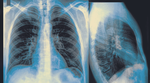 肺癌出国治疗：英国新检测手段可以早期发现肺癌