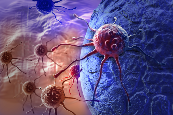癌症出国治疗：胰腺癌怎么治疗？新研究可为胰腺癌放射治疗提供新方向