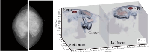 乳腺癌如何检查？日本开发出一种新技能可用于早期检测乳腺癌