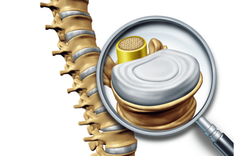 新研究开发出功能强大的新工具来预测患者是否出现脊柱骨折