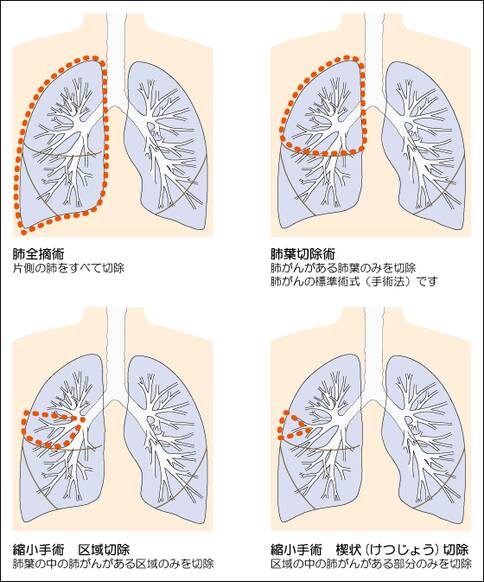 日本肺癌手术治疗方法