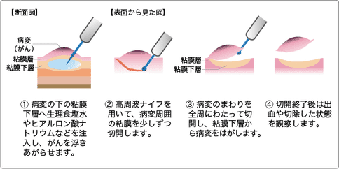 日本早期结直肠癌治疗