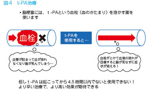 日本红十字会总医院治疗脑梗塞的方法