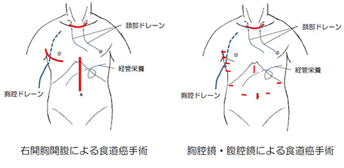 食道癌手术治疗