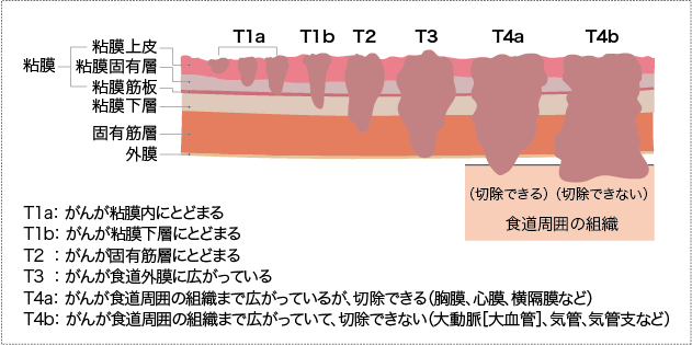 食道癌分期