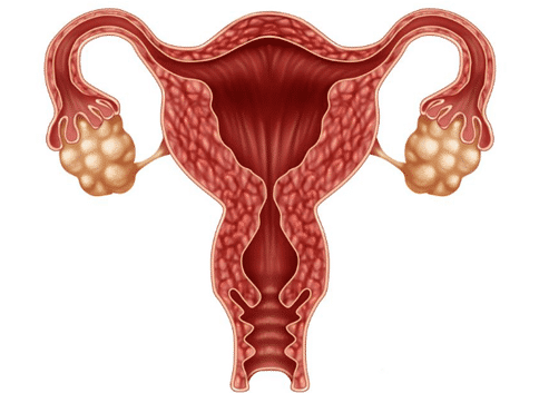 早期卵巢癌治疗