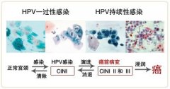 HPV感染治疗技术,HPV感染