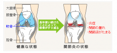 骨关节炎,骨关节炎治疗,日本治疗骨关节炎