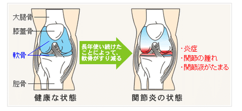 日本骨关节炎治疗方法