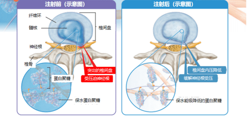 日本治疗腰椎间盘突出-2020日本腰椎间盘突出治疗方法总结