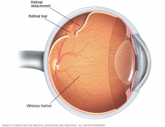 视网膜脱落治疗技术,视网膜脱离检查方法,视网膜