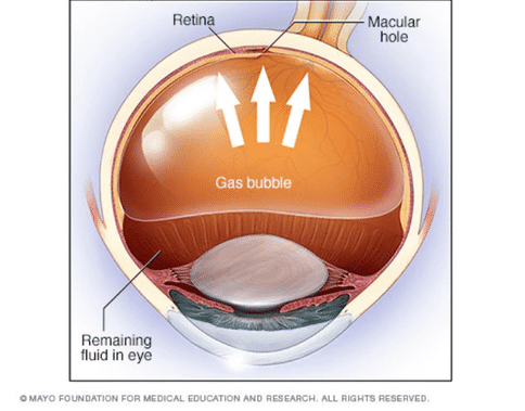 视网膜脱落手术
