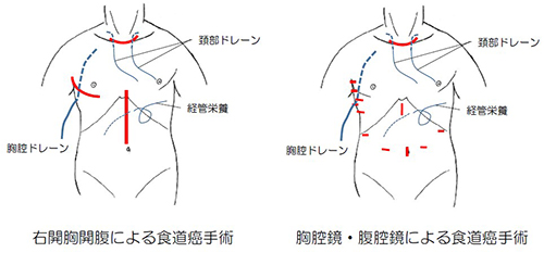 早期食道癌治疗