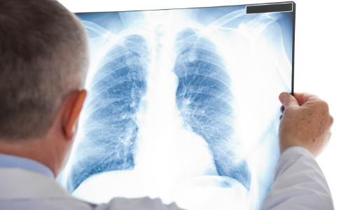 转移性肺癌靶向药-转移性肺癌靶向怎么用药