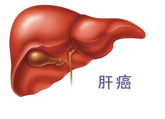 肝癌治疗