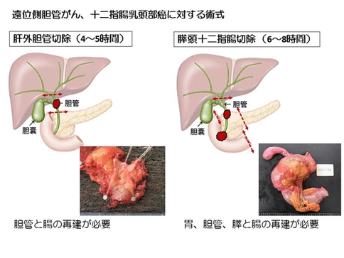 胆管癌手术治疗方案-日本胆管癌权威医院深度分析手术治疗方法