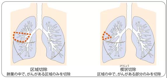 肺癌手术治疗