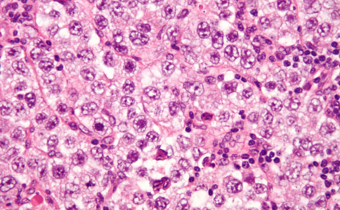 恶性生殖细胞瘤