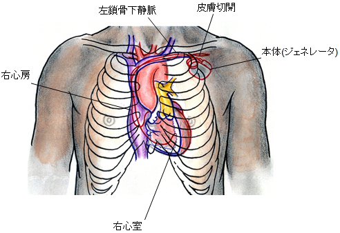 心律不齐治疗