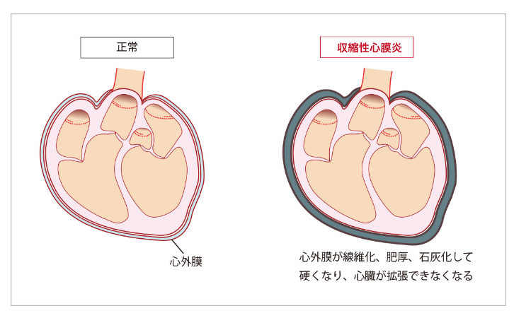 缩窄性心包炎治疗方法