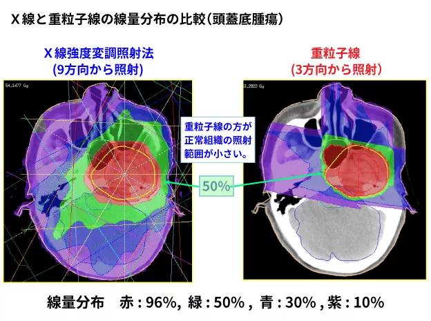 日本重离子治疗医院