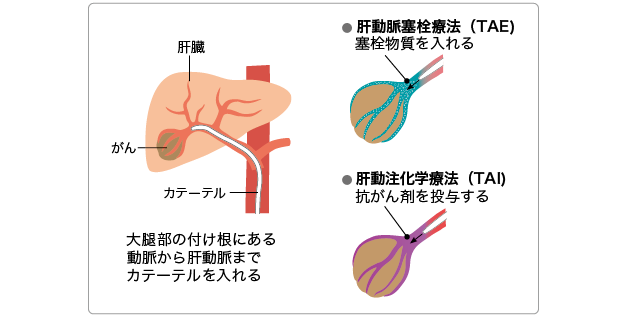 肝癌介入治疗