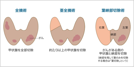 甲状腺癌治疗