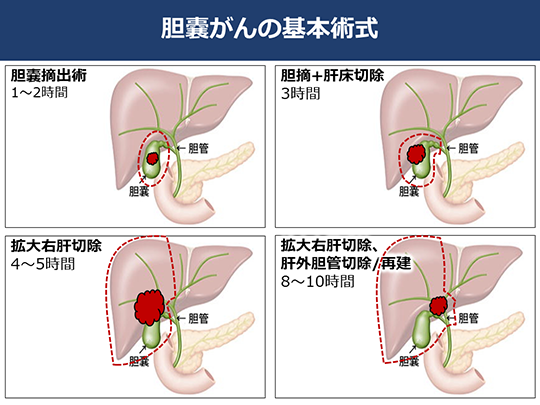 胆囊癌日本治疗方法