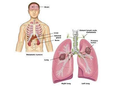 肺癌脑转移