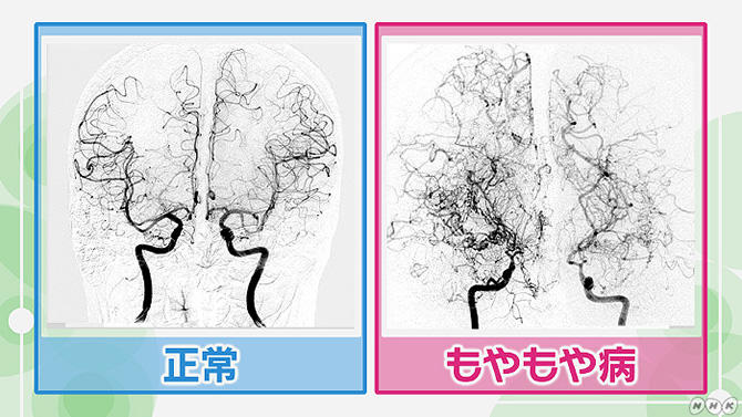 烟雾病内科治疗