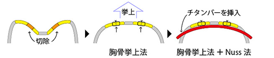 漏斗胸手术治疗