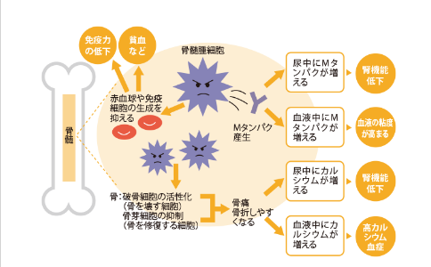 日本治疗多发性骨髓瘤